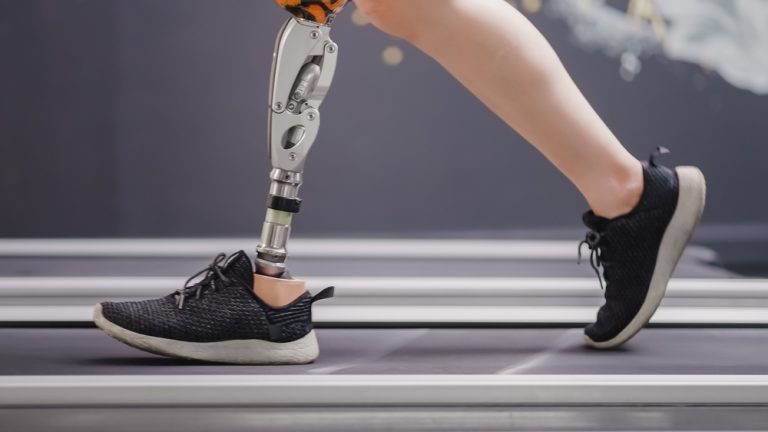 amputation caused by medical negligence