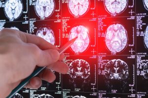 brain scan