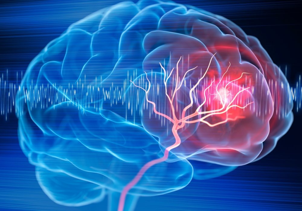 X-,Ray,Illustration,Of,Brain,Stroke,-,3d,Illustration