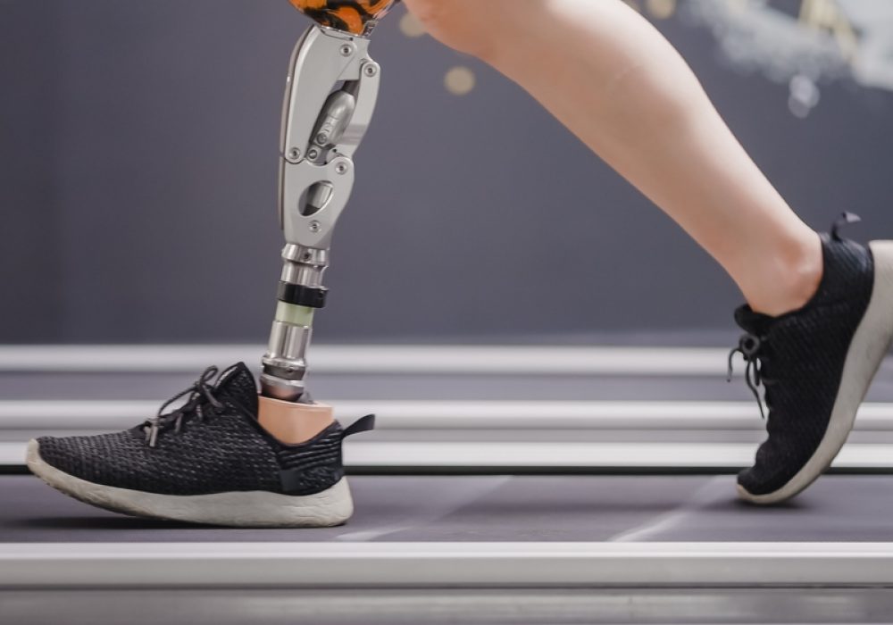 amputation caused by medical negligence
