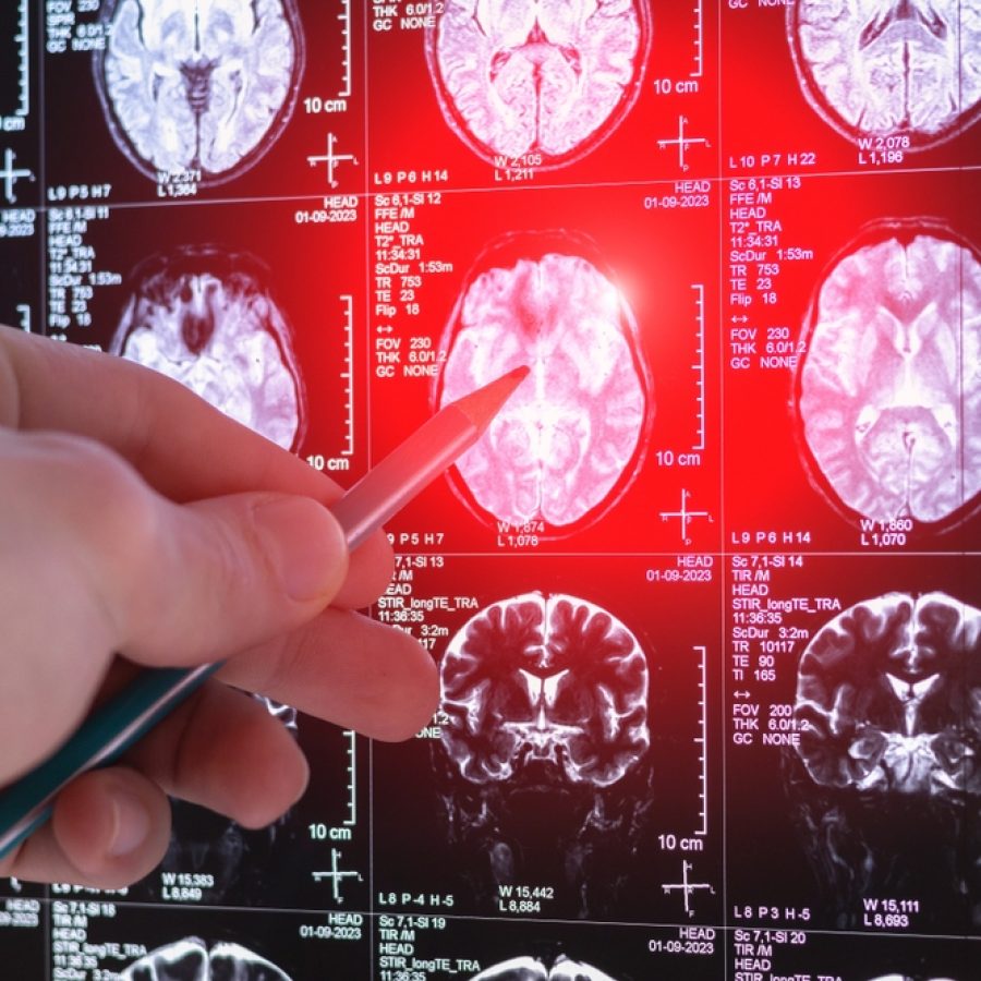 brain scan