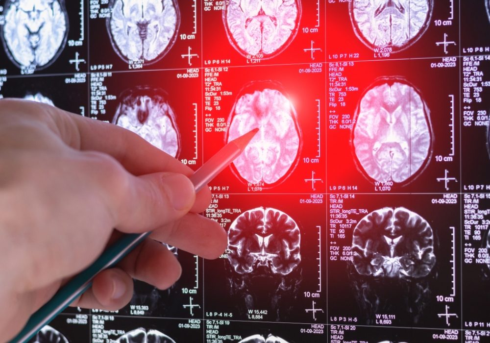 brain scan