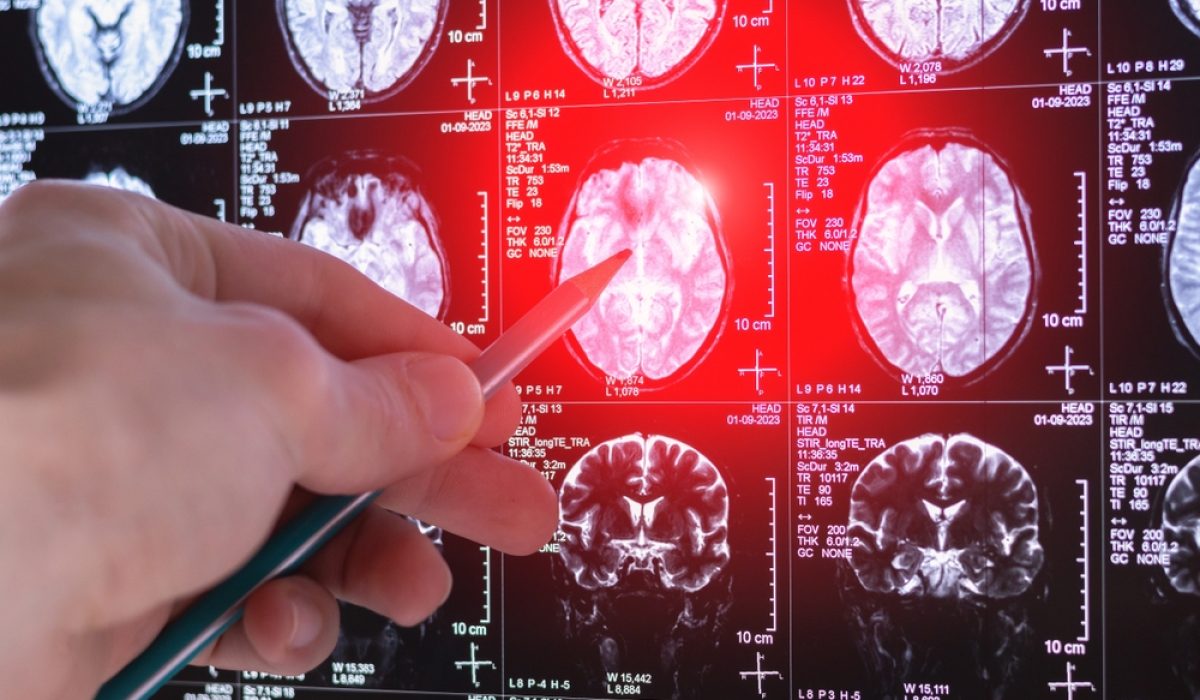 brain scan